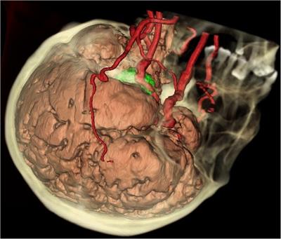 Exposure region of the Kawase approach and its correlation with skull base anatomy: An evaluation with digital models
